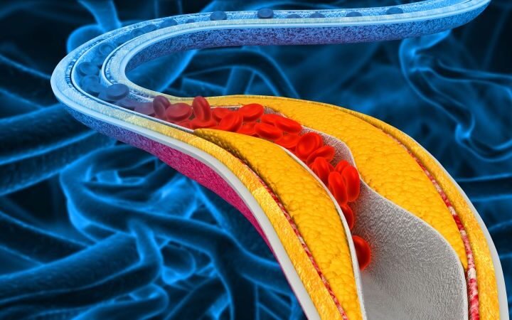 Experimental oral pill shows promise in lowering cholesterol for patients with statin resistance