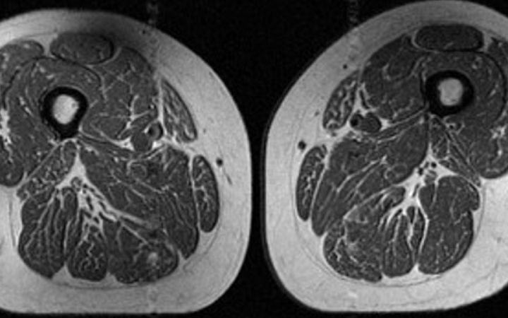 Ultraprocessed diets linked to alarming levels of intramuscular fat in older adults