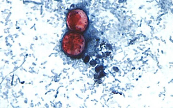 Cyclospora parasite outbreak linked to raw produce affects multiple US states
