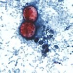 Diarrhea outbreak linked to parasite expands, with over 1,600 cases confirmed in the US