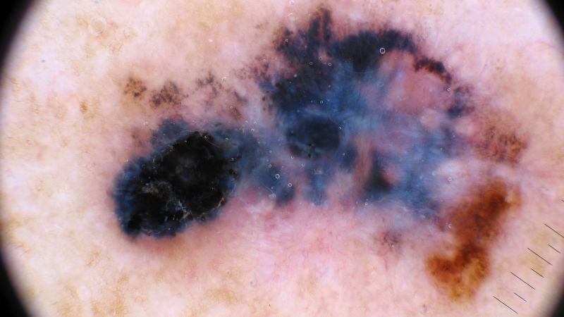 Moderna and Merck's personalized cancer vaccine marks significant advance in treatment options
